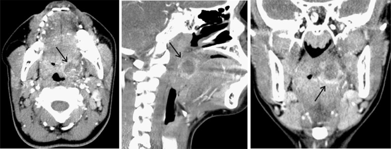 Lemierre Syndrome
